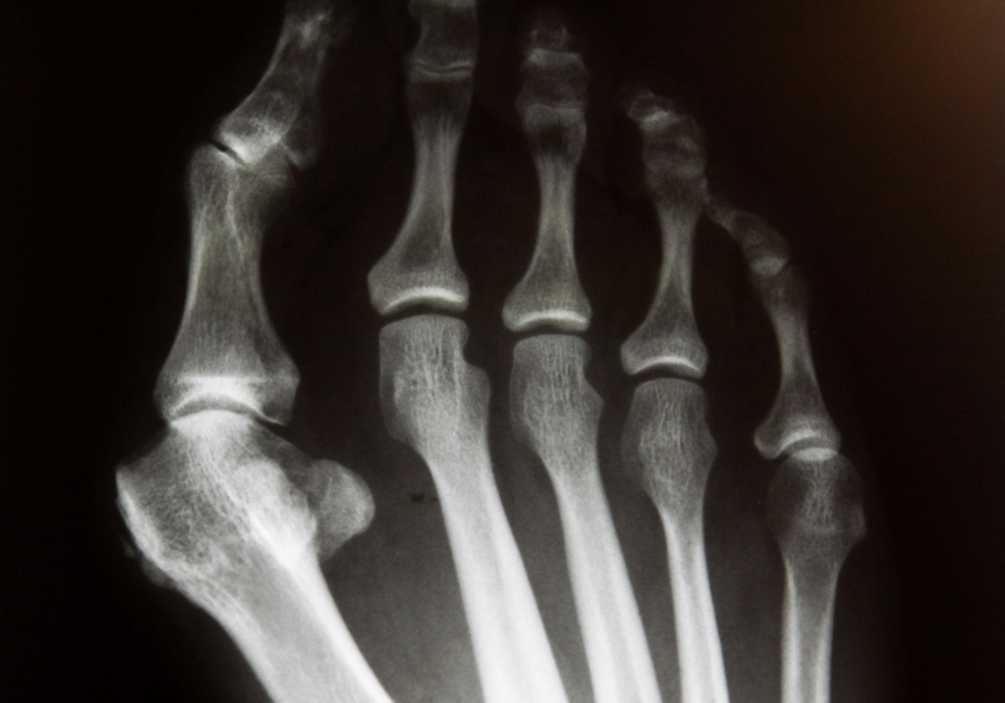 förebygga hallux valgus