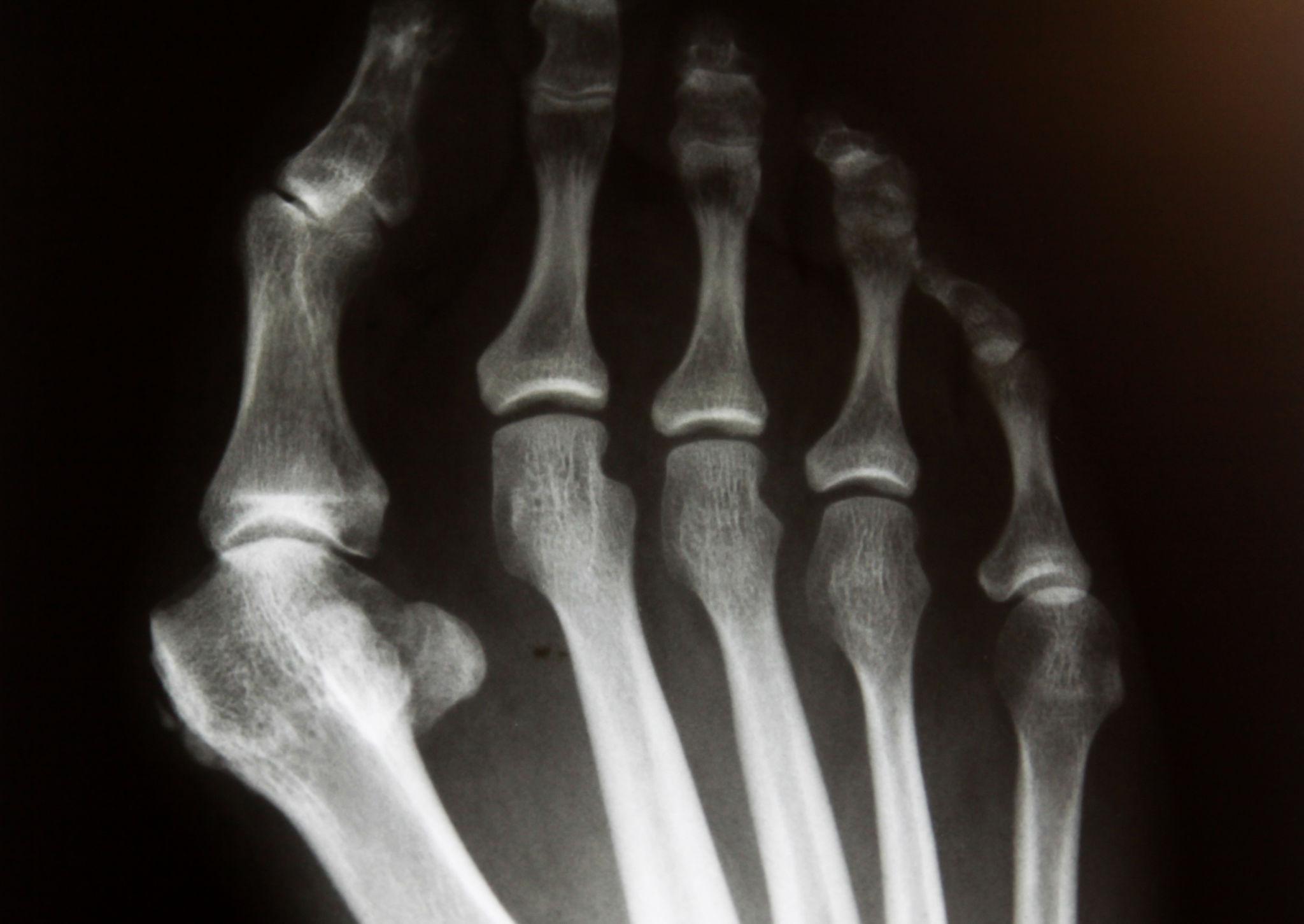 förebygga hallux valgus